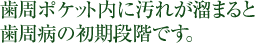 歯周ポケット内に汚れが溜まると歯周病の初期段階です。 