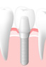 インプラントのイメージ